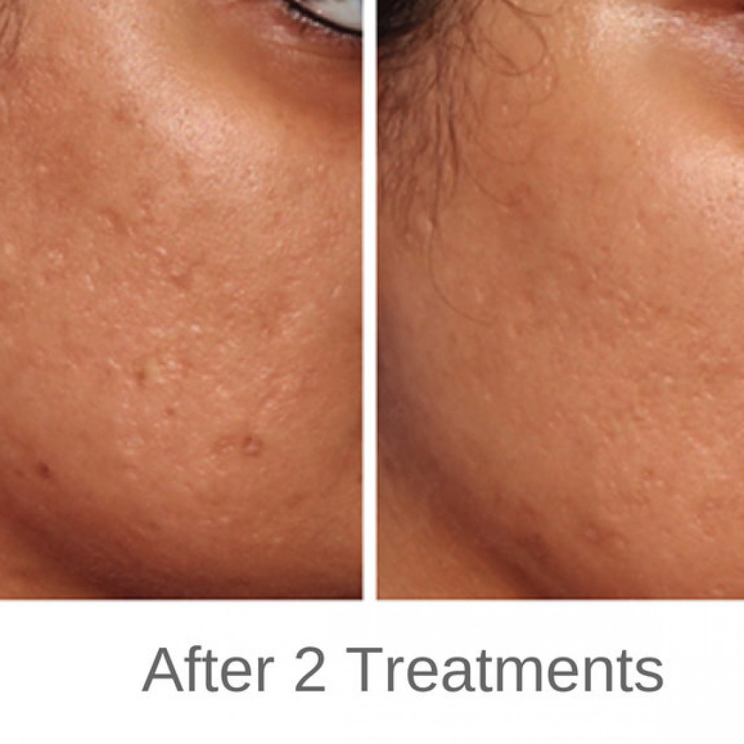 Micro Needling With PRP Heights Dermatology And Aesthetics